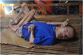 Menurut sebuah studi oleh Dr. Nguyen Viet Nhan, anak-anak di daerah di mana Agen Oranye digunakan telah terpengaruh dan memiliki banyak masalah kesehatan, termasuk langit-langit mulut sumbing, cacat mental, hernia, dan jari tangan dan kaki ekstra.